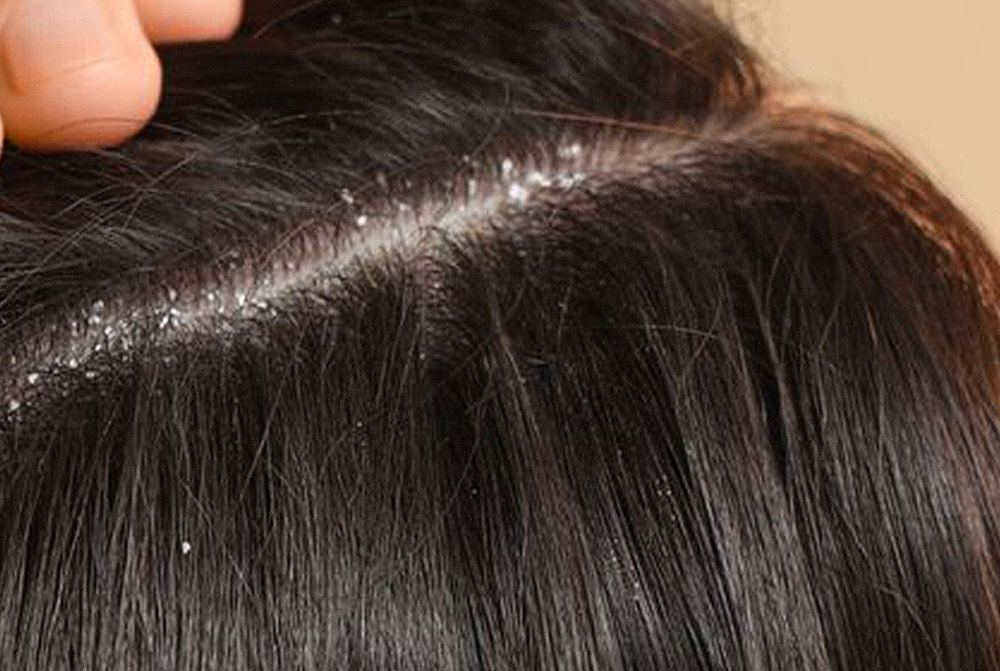 Close-up of scalp with dandruff on a beige background